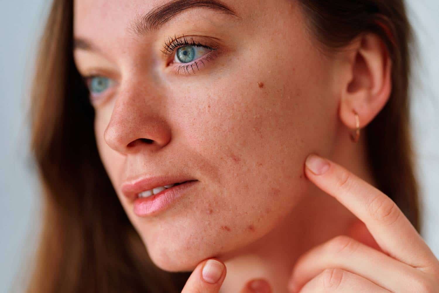Causas y Tratamientos para las Manchas en la Cara: Todo lo que Necesitas Saber