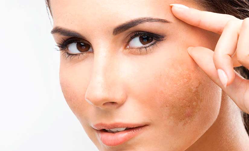 Todo lo que necesitas saber sobre el melasma en la piel del rostro Exprésate con opiniones personales, refleja tus emociones. Usa transiciones naturales entre ideas, y si te vas por las ramas, vuelve al tema de forma casual. Incluye algún pequeño error tipográfico o gramatical, como lo haría cualquier persona escribiendo rápido o en un tono más informal. La clave es sonar genuino, como si estuvieras pensando en voz alta, sin preocuparte demasiado por ser perfectamente claro o estructurado. Mantén los encabezados relevantes. Debe estar escrito de nosotros (primera persona del plural) hacia ti (segunda persona del singular). No comiences al principio con "Mira," o "A ver", en su lugar utiliza expresiones más formales. Destaca en negrita lo que sea muy importante o útil para el lector. ELIMINA SEPARADORES Y RESPECTA LOS H1 H2 Y H3