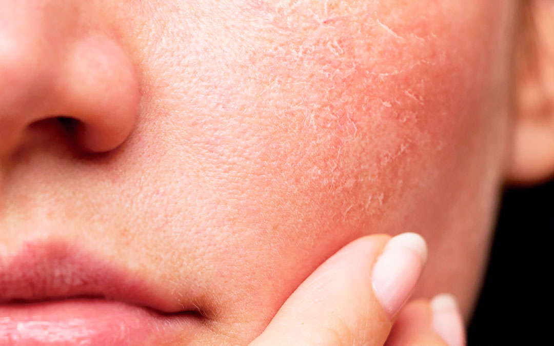 Cara irritada después de limpieza facial: causas y soluciones efectivas
